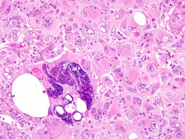 21A2 Ependymoma, giant cell (Case 21) H&E 1.jpg