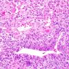 21A3 Ependymoma, giant cell (Case 21) H&E 3.jpg