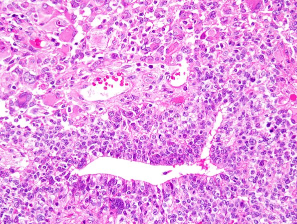 21A3 Ependymoma, giant cell (Case 21) H&E 3.jpg