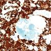 21B1 Ependymoma, giant cell (Case 21) GFAP 1.jpg