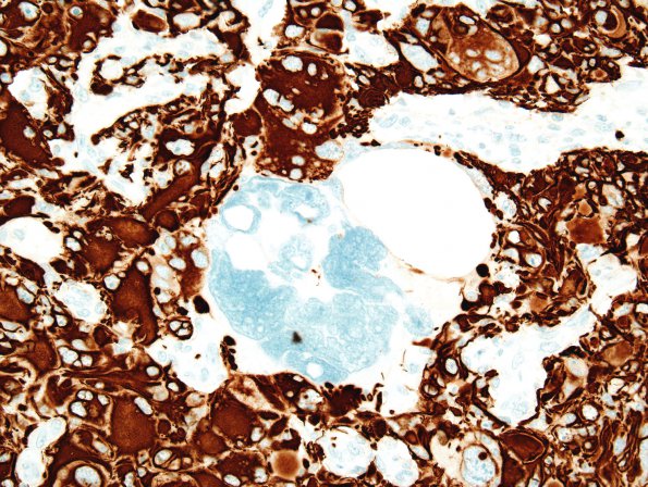 21B1 Ependymoma, giant cell (Case 21) GFAP 1.jpg