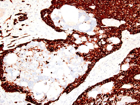 21B2 Ependymoma, giant cell (Case 21) GFAP 2.jpg