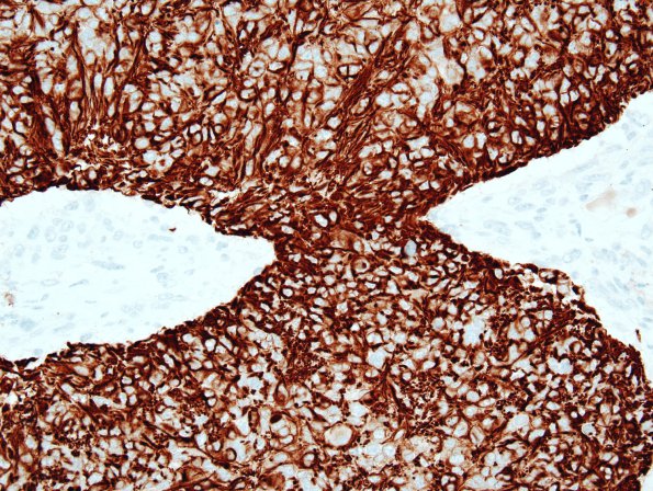 21B3 Ependymoma, giant cell (Case 21) GFAP 3.jpg