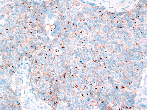 21C1 Ependymoma, giant cell (Case 21) D2-40 3.jpg