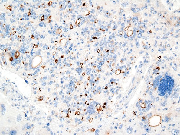 21D Ependymoma, giant cell (Case 21) EMA 1.jpg