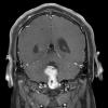 22A Ependymoma, WHO II (Case 22) T1 with contrast - Copy