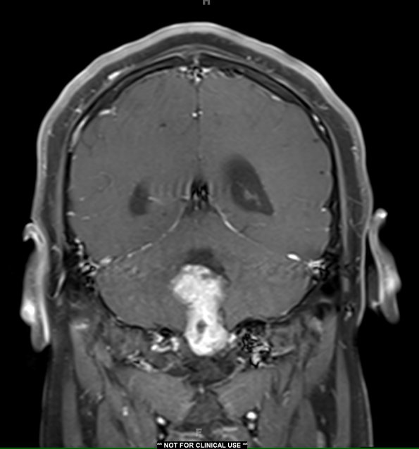 22A Ependymoma, WHO II (Case 22) T1 with contrast - Copy