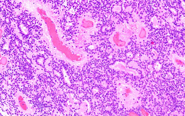 22B Ependymoma, WHO II (Case 22) H&E 3