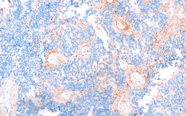 22D1 Ependymoma, WHO II (Case 22) EMA 1