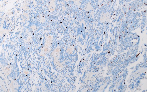 22E Ependymoma, WHO II (Case 22) Ki67