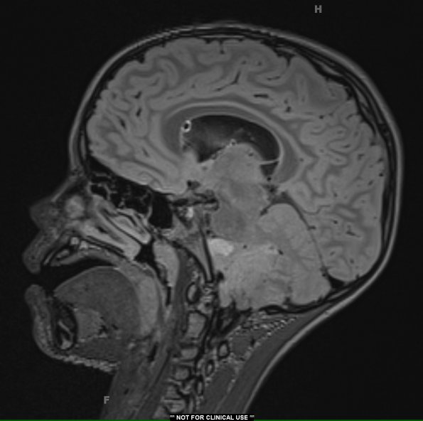 23A Ependymoma, focal anaplasia (WHO III) (Case 23) FLAIR 1 - Copy