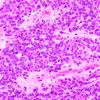 23B Ependymoma, focal anaplasia (WHO III) (Case 23) H&E 1