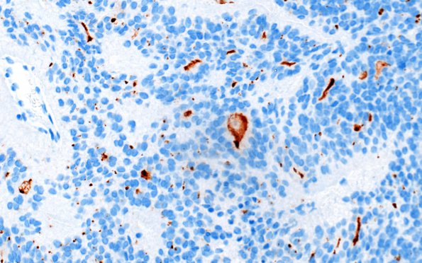 23D Ependymoma, focal anaplasia (WHO III) (Case 23) EMA 2