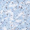 23E Ependymoma, focal anaplasia (WHO III) (Case 23) Ki-67 1