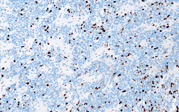 23E Ependymoma, focal anaplasia (WHO III) (Case 23) Ki-67 1