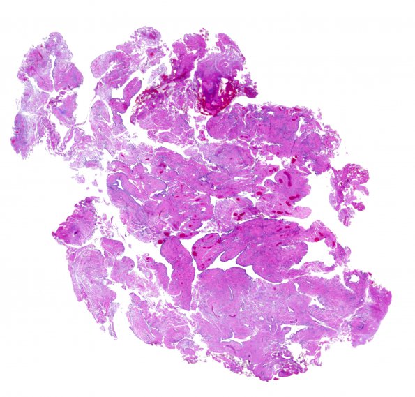 24A1 Ependymoma, WHO II (Case 24) H&E WM