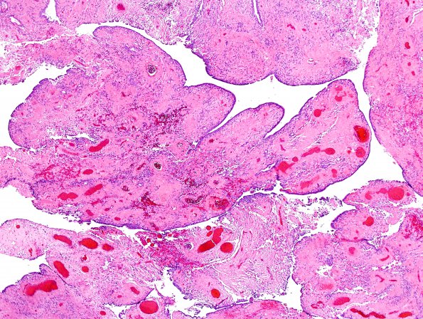 24A2 Ependymoma, WHO II (Case 24) H&E 1.jpg