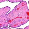 24A3 Ependymoma, WHO II (Case 24) H&E 2.jpg