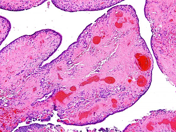 24A3 Ependymoma, WHO II (Case 24) H&E 2.jpg