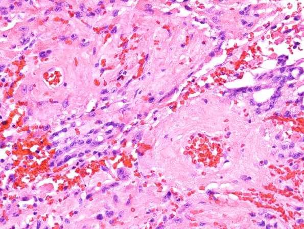 24A4 Ependymoma, WHO II (Case 24) H&E 5.jpg