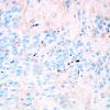 24C Ependymoma, WHO II (Case 24) EMA 1.jpg