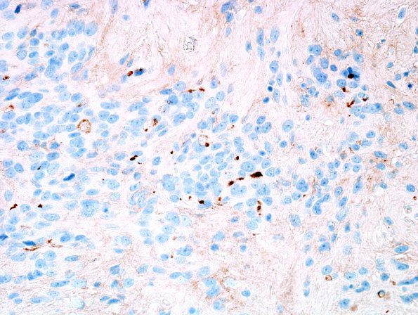 24C Ependymoma, WHO II (Case 24) EMA 1.jpg