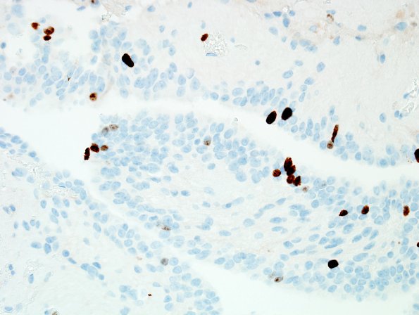 24D Ependymoma, WHO II (Case 24) Ki67 1.jpg