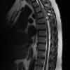 25A Ependymoma, focal anaplasia, Grade III (Case 25) T2 1