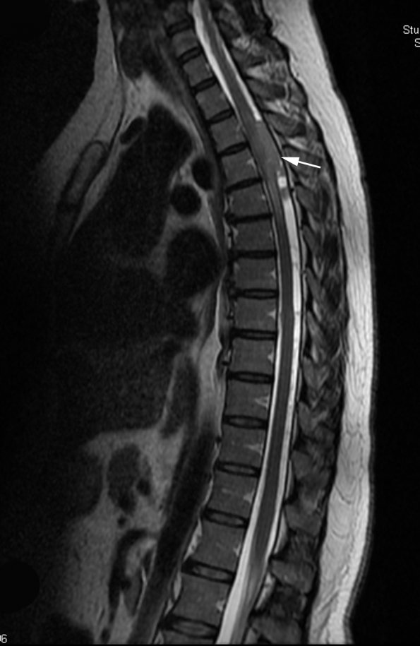 25A Ependymoma, focal anaplasia, Grade III (Case 25) T2 1