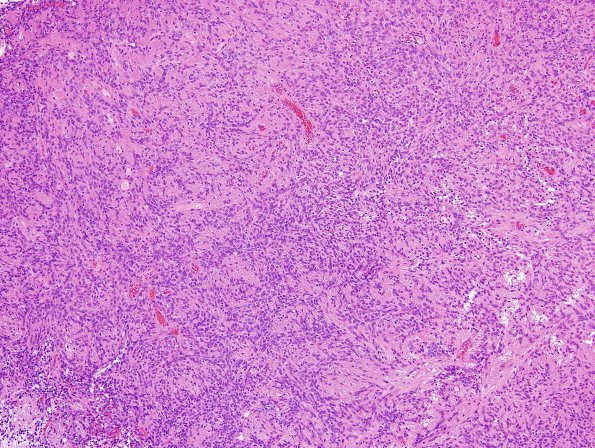 25B1 Ependymoma, focal anaplasia, Grade III (Case 25) H&E 1.jpg