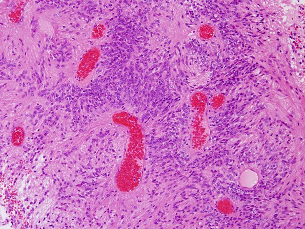 25B2 Ependymoma, focal anaplasia, Grade III (Case 25) H&E 7.jpg