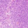 25B3 Ependymoma, focal anaplasia, Grade III (Case 25) H&E 3.jpg