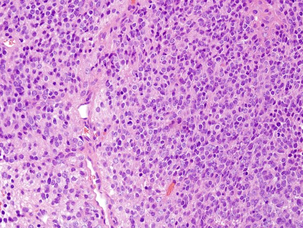 25B3 Ependymoma, focal anaplasia, Grade III (Case 25) H&E 3.jpg