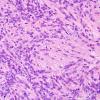 25B4 Ependymoma, focal anaplasia, Grade III (Case 25) H&E 2.jpg