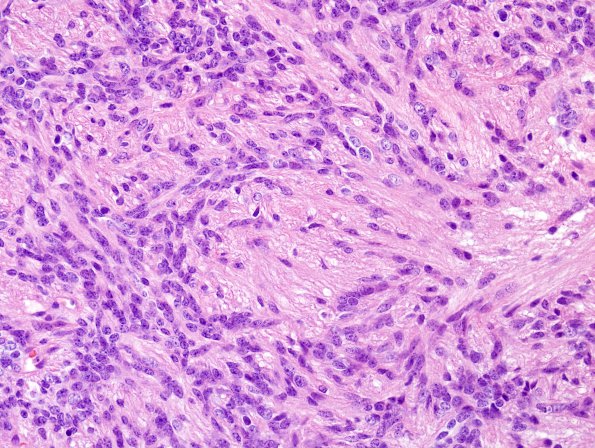 25B4 Ependymoma, focal anaplasia, Grade III (Case 25) H&E 2.jpg