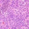 25B5 Ependymoma, focal anaplasia, Grade III (Case 25) H&E 5.jpg