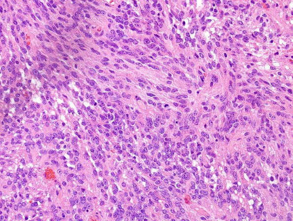 25B5 Ependymoma, focal anaplasia, Grade III (Case 25) H&E 5.jpg