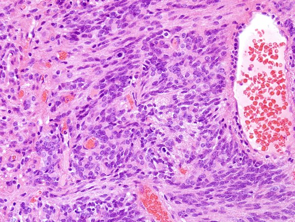 25B6 Ependymoma, focal anaplasia, Grade III (Case 25) H&E 6.jpg