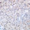 25D Ependymoma, focal anaplasia, Grade III (Case 25) D2-40 1.jpg