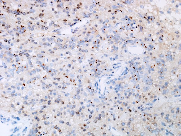 25D Ependymoma, focal anaplasia, Grade III (Case 25) D2-40 1.jpg