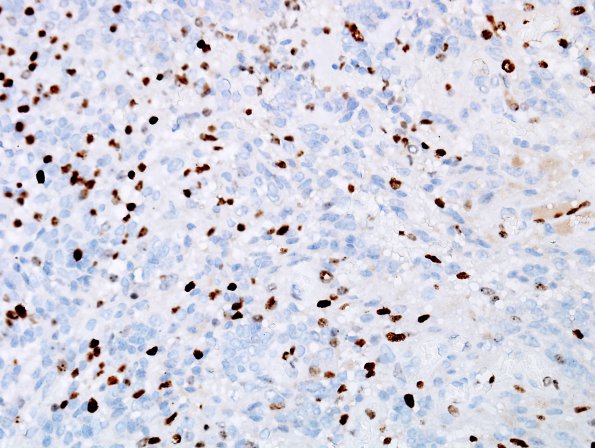 25E Ependymoma, focal anaplasia, Grade III (Case 25) Ki67 1.jpg