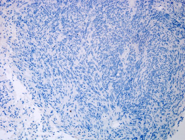 25F Ependymoma, focal anaplasia, Grade III (Case 25) NF 2.jpg