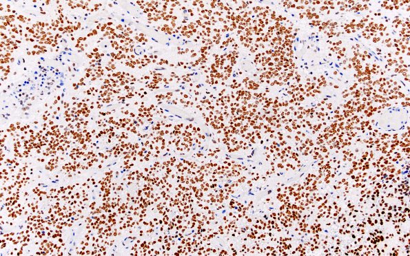 26F Ependymoma, Grade III, ZFTA fusion (Case 26) BRG1