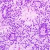 2B1 Ependymoma (Case 2) H&E 1