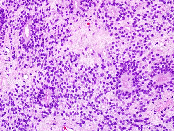 2B1 Ependymoma (Case 2) H&E 1