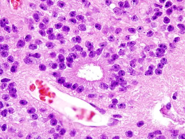 2B2 Ependymoma (Case 2) H&E 8