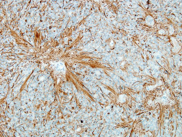 2C Ependymoma (Case 2) GFAP 2