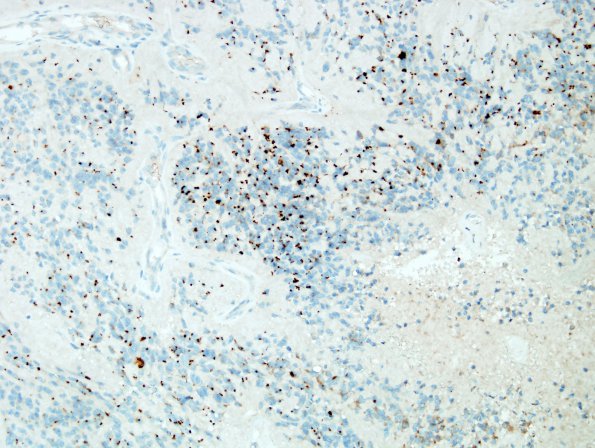 2D Ependymoma (Case 2) EMA 1