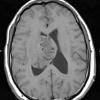 3A1 Ependymoma (Case 3) T1 4 - Copy