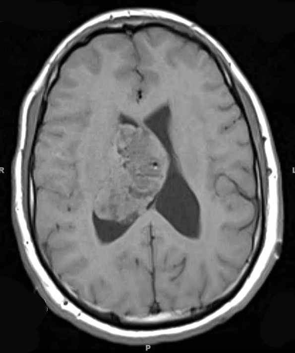 3A1 Ependymoma (Case 3) T1 4 - Copy